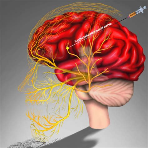 Migraine Nerves – Zygomaticotemporal Nerve Block – Mrimigraine.com