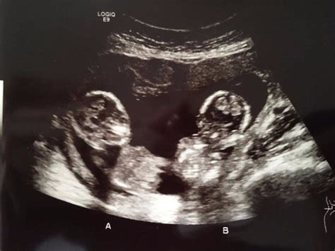 New twin ultrasound pic!! | BabyCenter