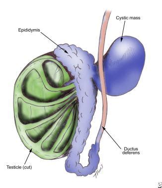 Spermatocele: Practice Essentials, History of the Procedure, Problem