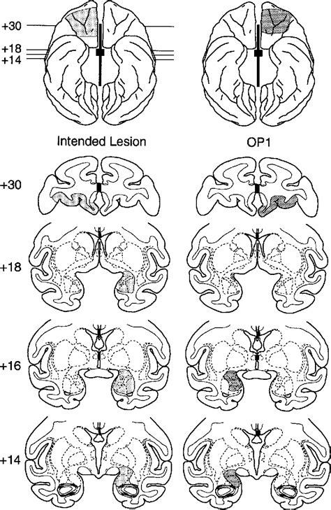 split brain | Semantic Scholar