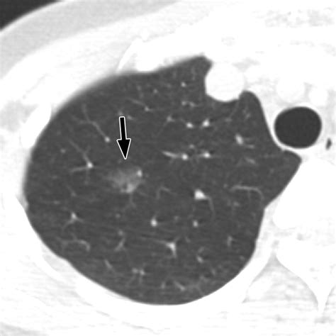 Pure Ground-Glass Opacity Neoplastic Lung Nodules: Histopathology, Imaging, and Management | AJR