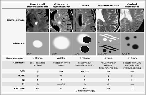 Update on cerebral small vessel disease: a dynamic whole-brain disease | Stroke and Vascular ...