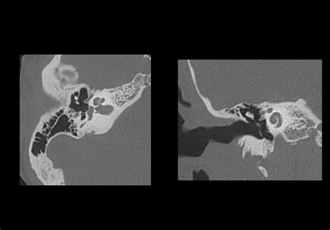 Petrous bone CT: normal anatomy | e-Anatomy