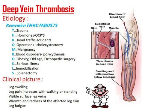 DEEP VEIN THROMBOSIS - CAUSES AND SELF HELP | Nursing mnemonics, Sonography student, Vascular ...