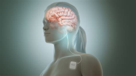 Vagus nerve stimulation - Wikipedia