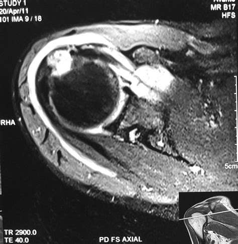 Radiodiagnosis - Imaging is Amazing-Interesting cases: Supraspinatus avulsion tear - MRI