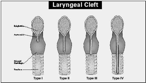 Laryngeal cleft info | SLP tools & resources | Occupational therapy, Tools, Tableware