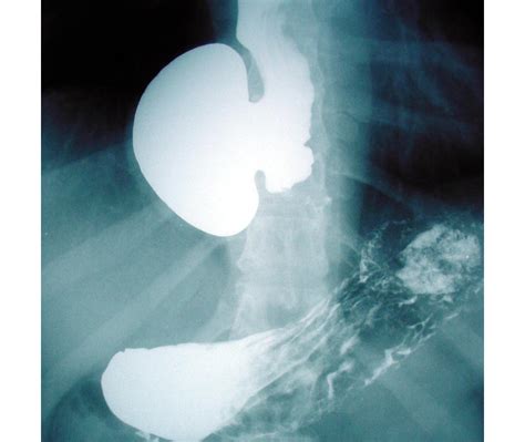 Esophagus Diverticulum 2398 Esophagus Epiphrenic Diverticulum | Surgery Photos