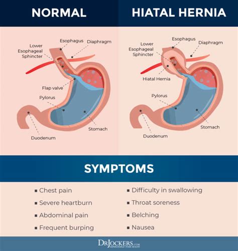 Hiatal Hernia: Symptoms, Causes and Natural Support Strategies