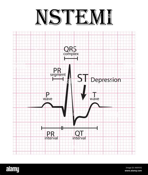 ECG nicht ST Höhe Myokardinfarkt (NSTEMI) und EKG (P-Welle, QT-Intervall, PR-Segment, PR ...