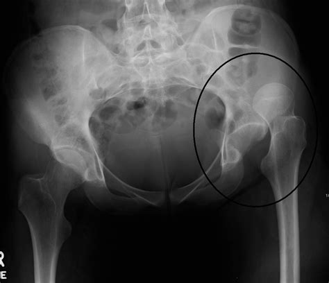 Posterior Hip Dislocation reduced with a femoral block — Highland EM Ultrasound Fueled pain ...