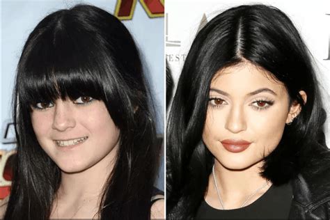 Kylie Jenner Before And After Plastic Surgery Photos