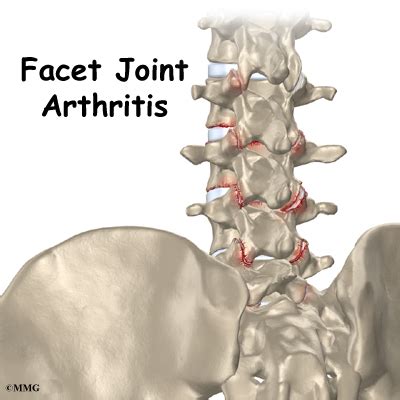 Vertebral Facet