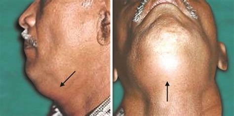 Deep neck infection causes, symptoms, diagnosis, treatment & prognosis