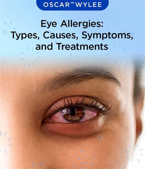 Eye Allergies: Types, Causes, Symptoms, and Treatments