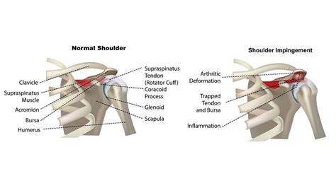 Shoulder Impingement Diagnosis