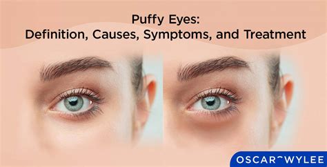 Puffy Eyes: Definition, Causes, Symptoms, and Treatment