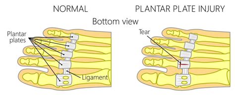 Capsulitis of the Second Toe Treatment [Taping, Orthotics & Best Shoes!]