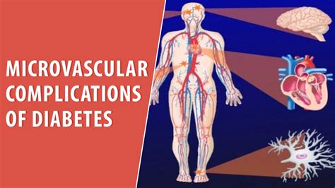 Microvascular Complications of Diabetes | CardioVisual | Trusted Patient Education Platform