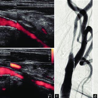 (a) After carotid artery stenting (CAS), the postoperative carotid ...