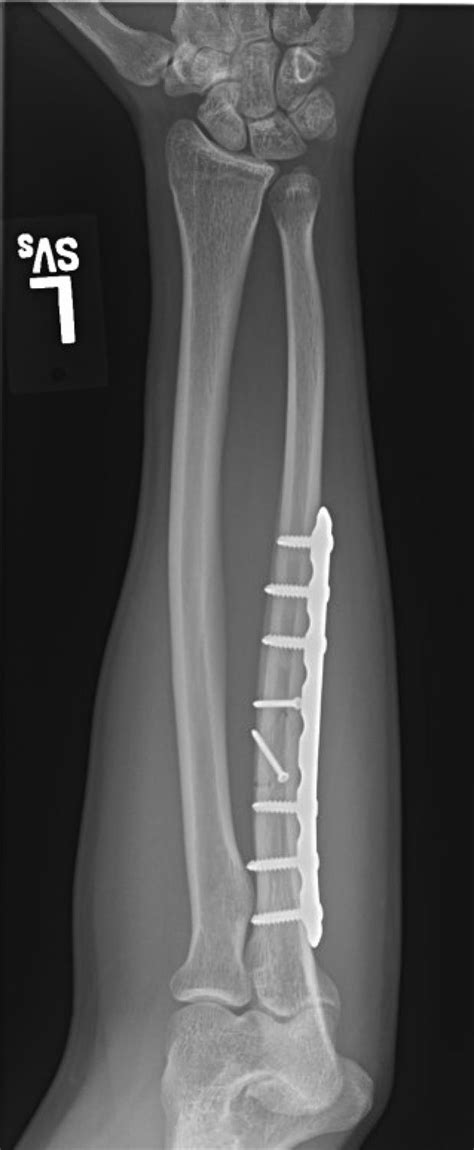 Ulna Bone Fracture