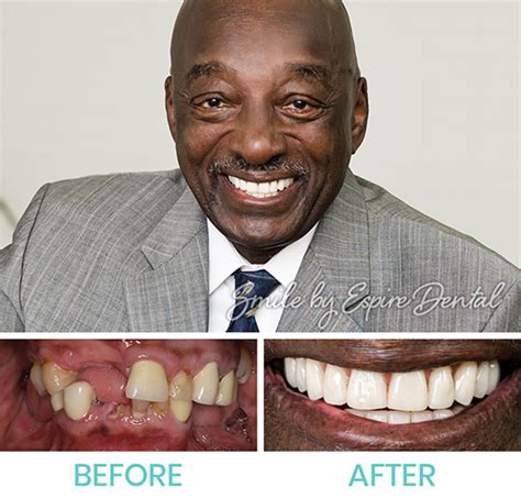 How to Replace a Missing Tooth | Espire Dental: CO