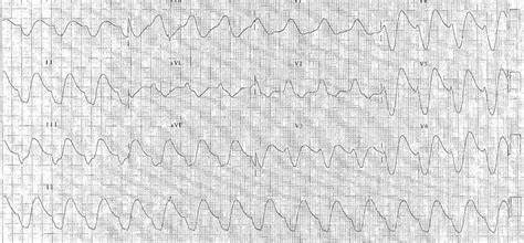 ECG of the Week – 7th April 2021 – Answer | Emergucate