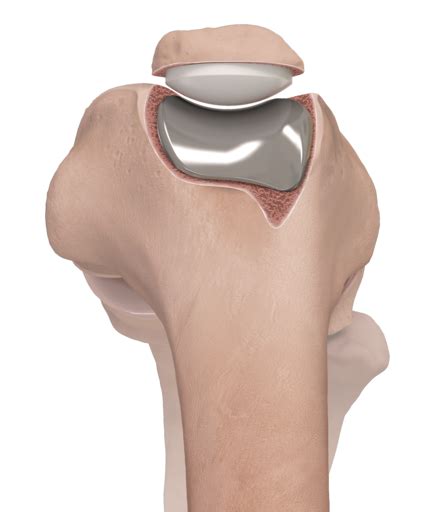 Arthrex - Patellofemoral Joint Arthroplasty (PFJ)