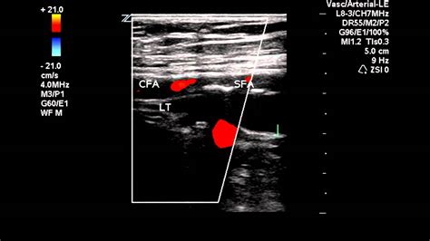 Lower Extremity Arterial Ultrasound Criteria