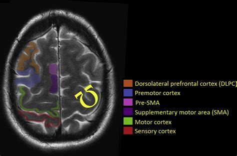 Supplementary Motor Area Mri