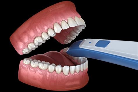 5 Tips and Tricks for Using Intraoral Digital Scanners - Today's RDH