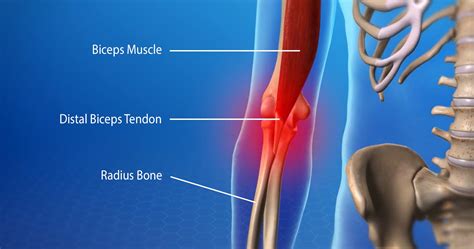 Biceps Tendinitis - Bút Chì Xanh