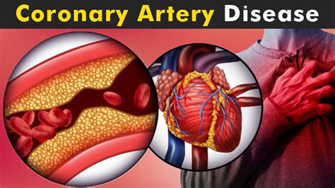 Coronary Artery Disease (CAD) - Causes, Symptoms, Treatment & Diagnosis ...