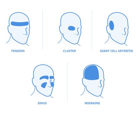 5 types of headache and their locations