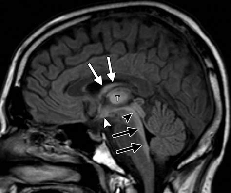 Wernicke's | Radiology, Neurology, Brain images