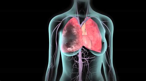 What are the Signs of a Pulmonary Embolism and Treatment Options - Tasteful Space