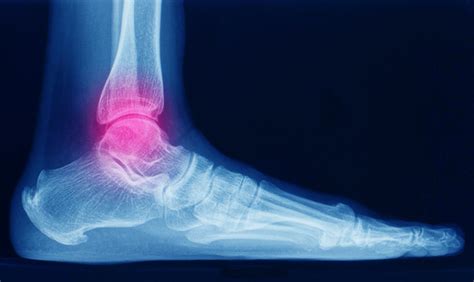 Ankle and foot fractures | Fernando Bidino