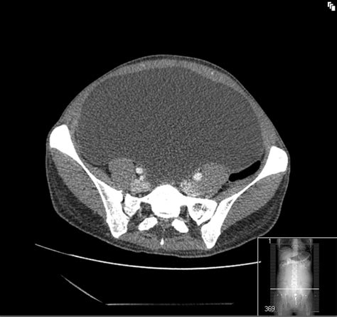 Giant mesenteric cyst: a rare cause of abdominal distension diagnosed ...