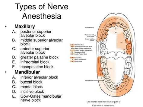 Anesthesia Block Types