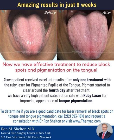 Black spots on tongue and pigmentation in NYC | Ruby Laser Resurfacing | Laser resurfacing ...