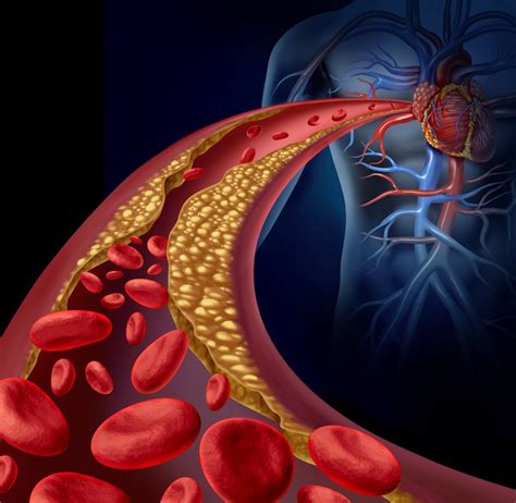 Arteriosclerosis and Atherosclerosis treatment in Philadelphia