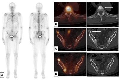 Frontiers | Imaging for Metastasis in Prostate Cancer: A Review of the Literature