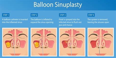 Balloon Sinus Procedures - Ohio Head and Neck Surgeons