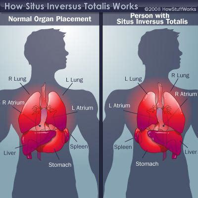 Situs Inversus With Dextrocardia & Heart Valve Surgery