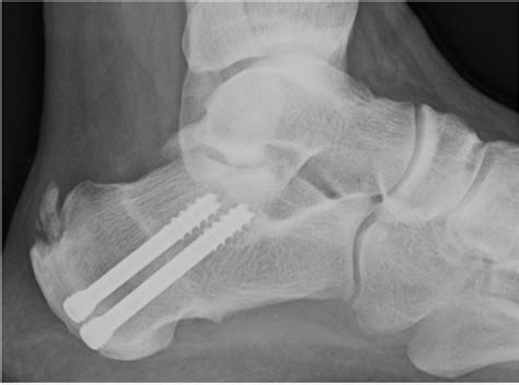 Postoperative X-ray of a dorsal wedge calcaneal osteotomy fixed with 2 ...