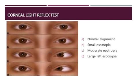 Pediatric Eye Examination