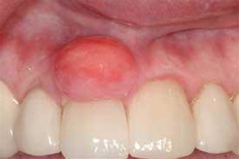 Peripheral Odontogenic Ossifying Fibroma | Registered Dental Hygienists