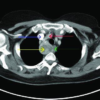 CT thorax revealed a right paratracheal region mass (yellow arrow) with ...