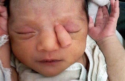 Trunklike Projection in 10-Day-Old Girl | Congenital Defects | JAMA Pediatrics | The JAMA Network