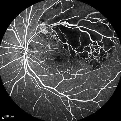 Non-perfused BRVO - Retina Image Bank